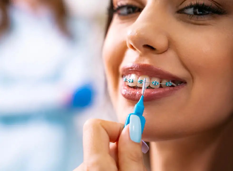 5 Steps To Getting Invisible Braces
